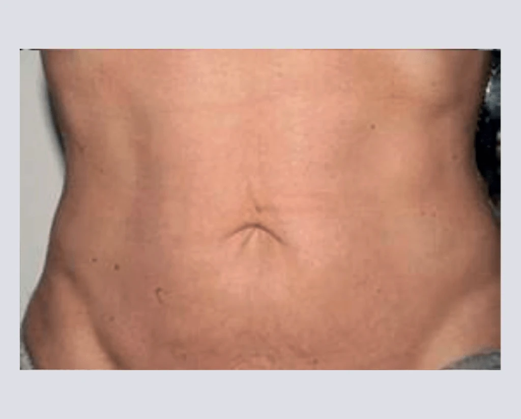 After 10 Treatments