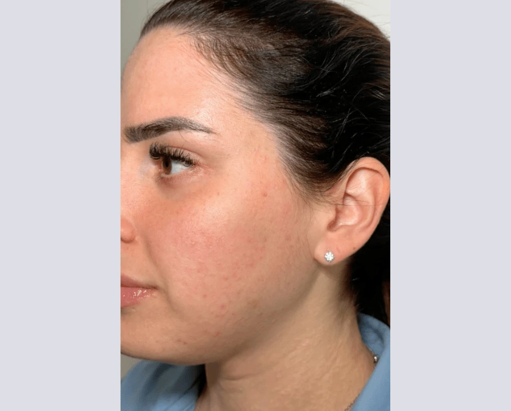 After 10 Treatments