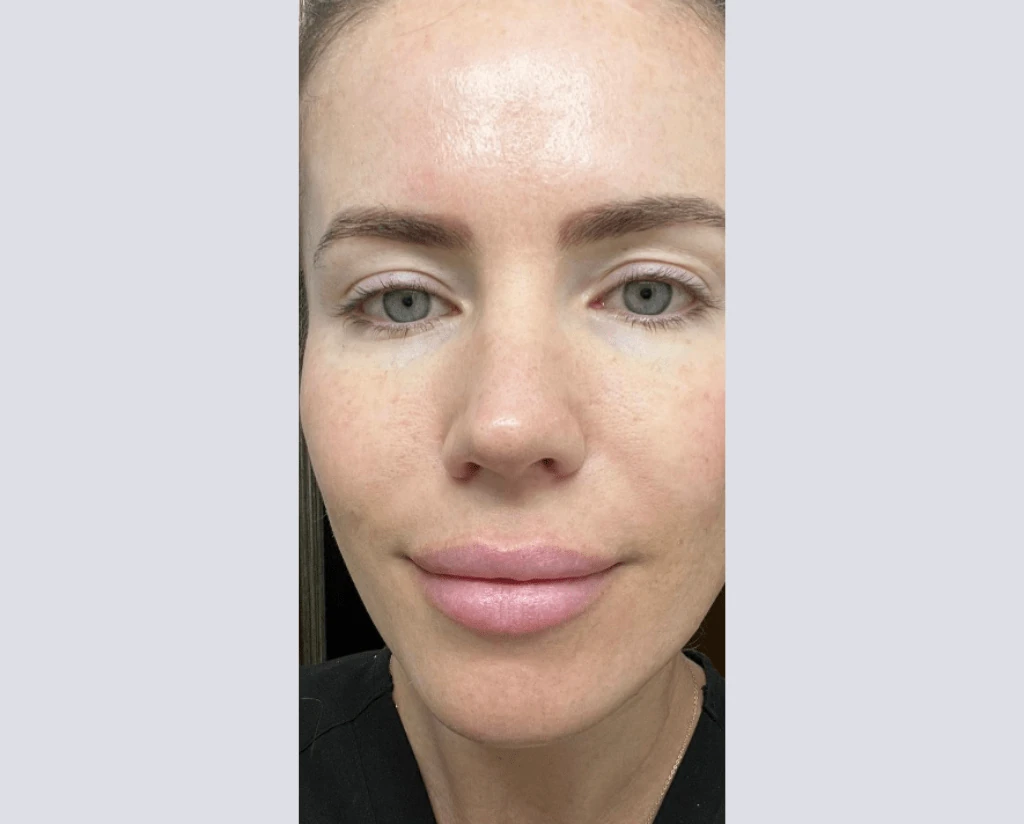 After 10 Treatments