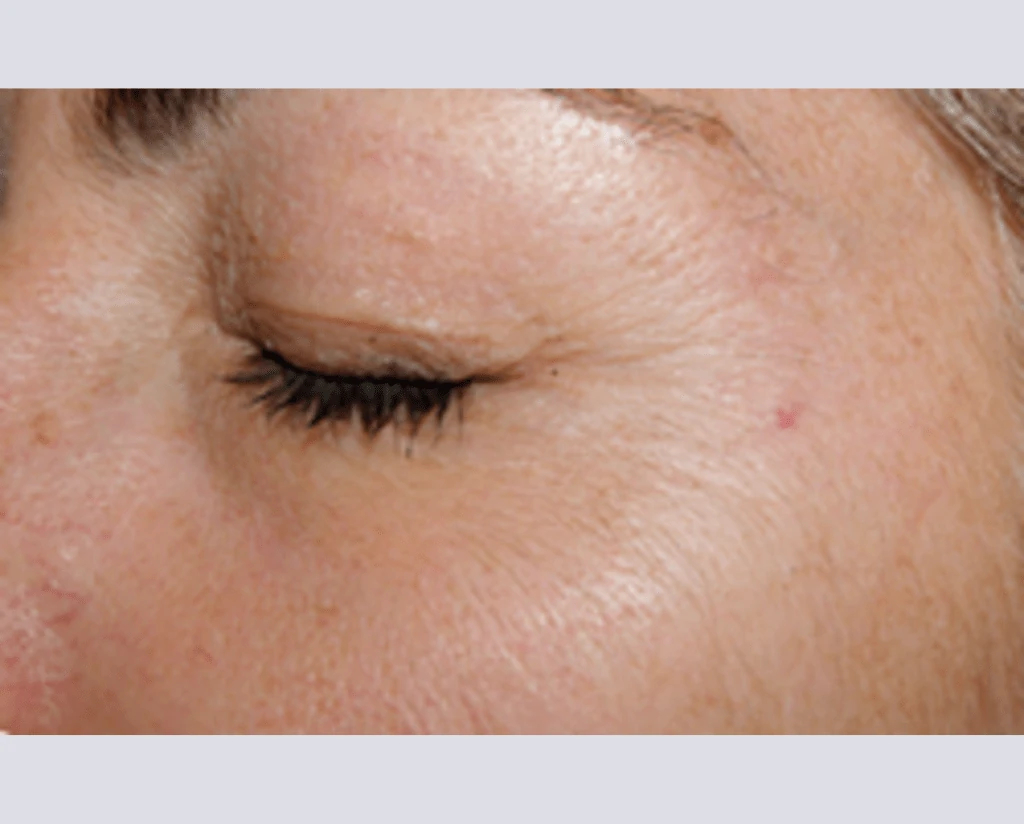After 10 Treatments