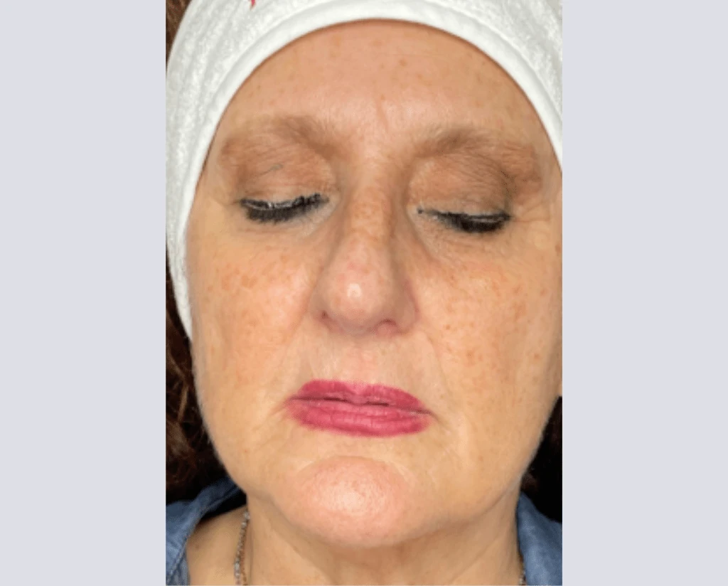 After 10 Treatments
