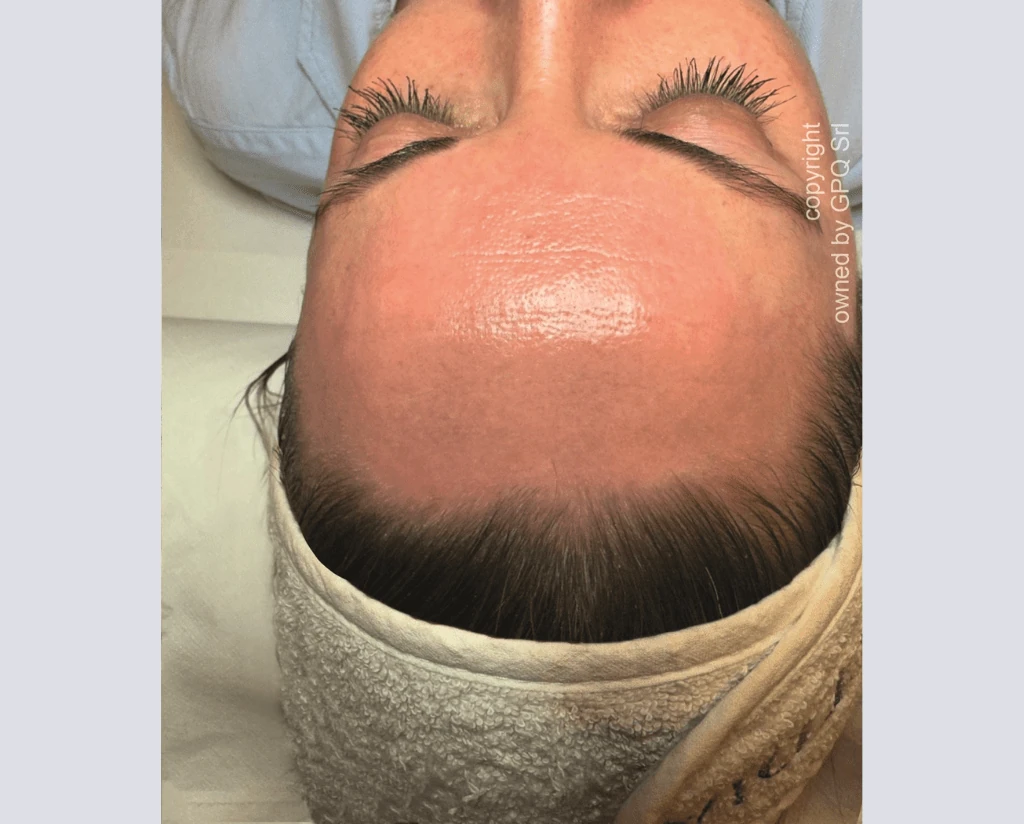 After 10 Treatments