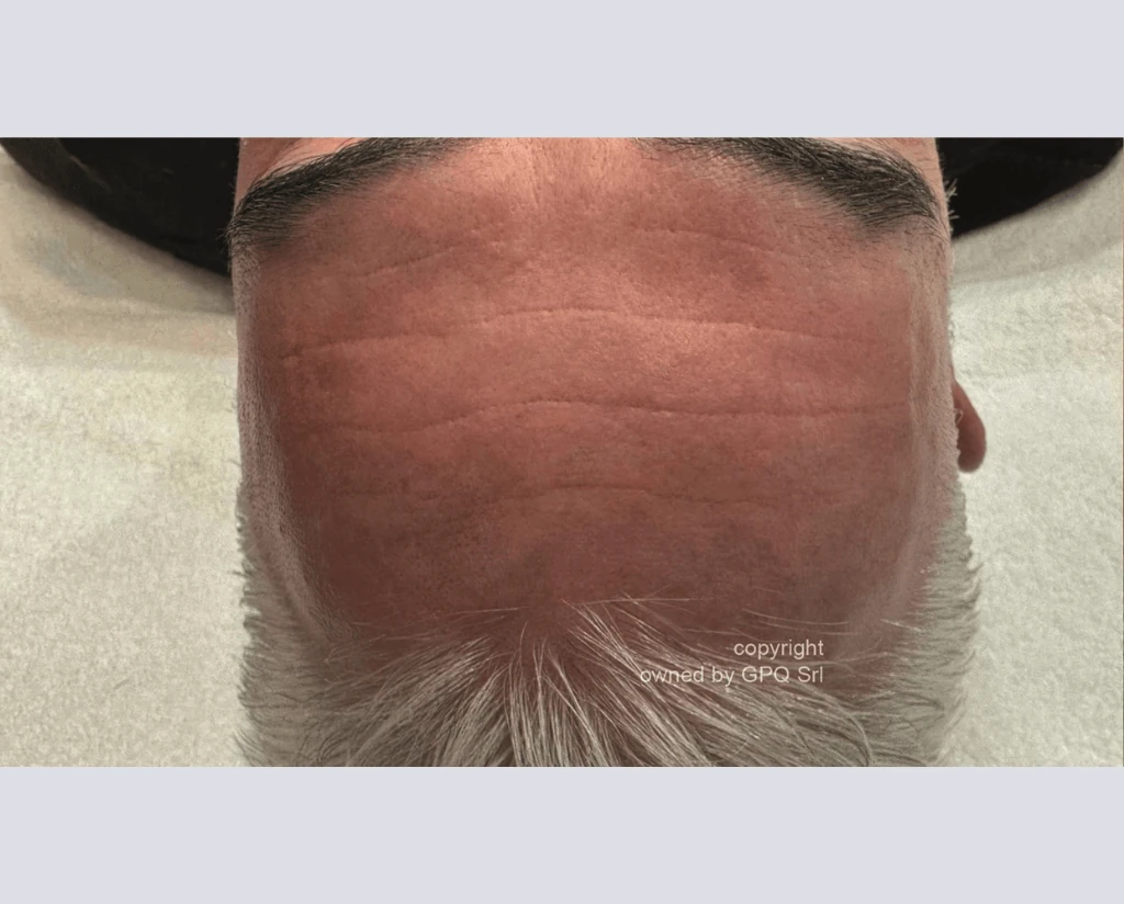 After 10 Treatments