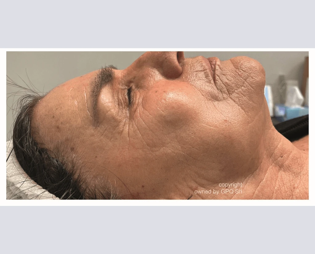 After 10 Treatments