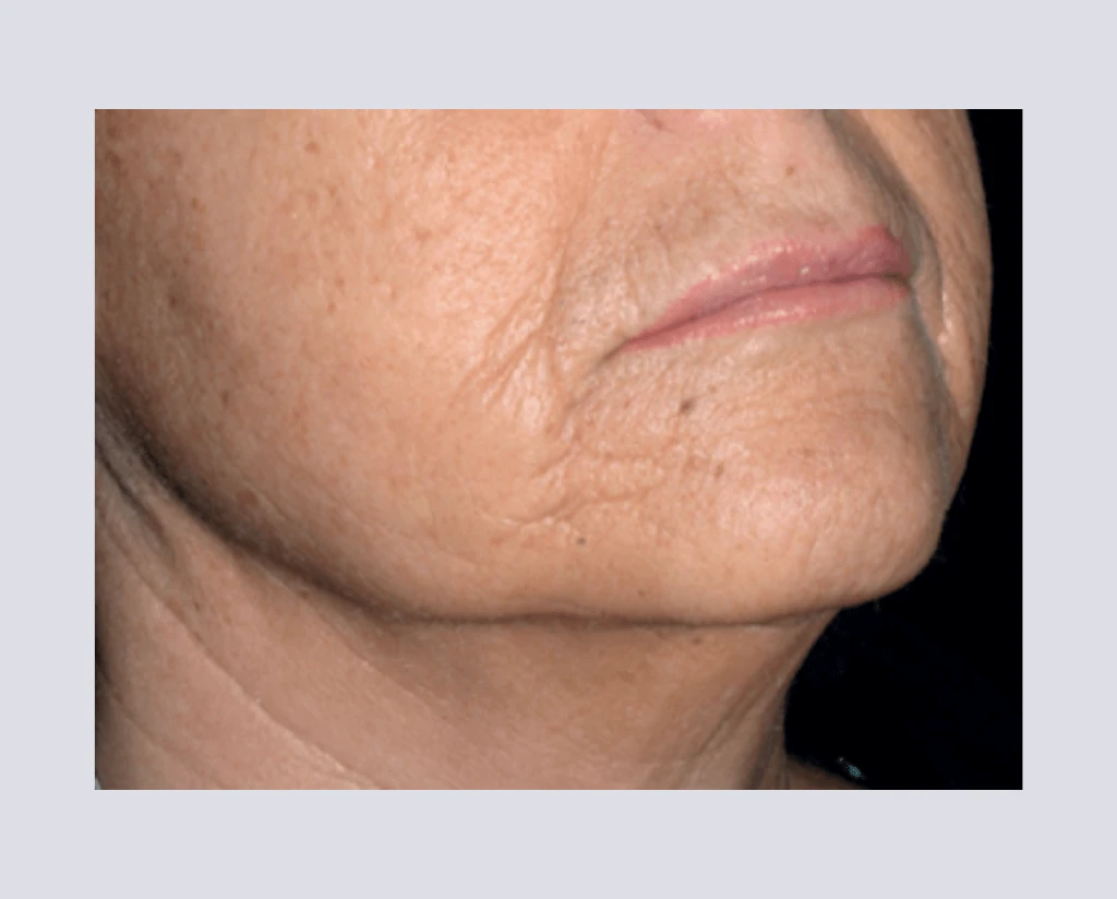 After 10 Treatments
