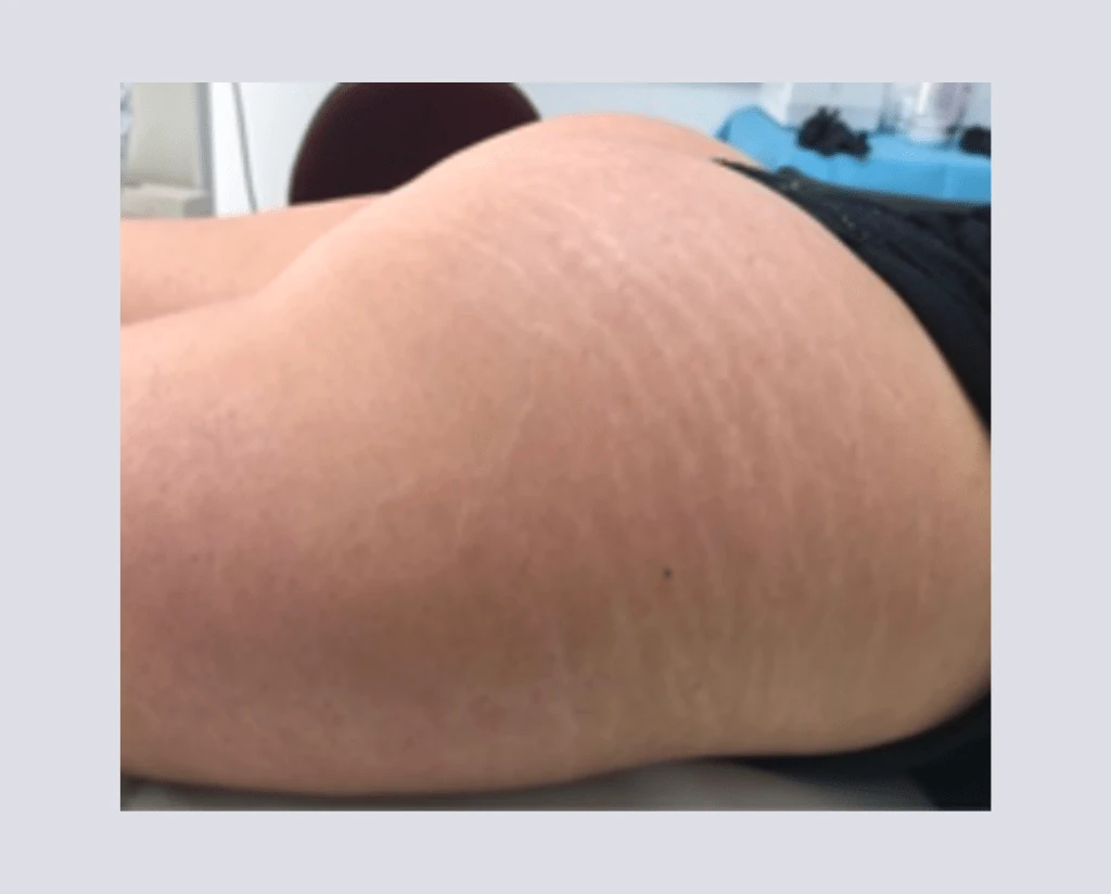 After 10 Treatments