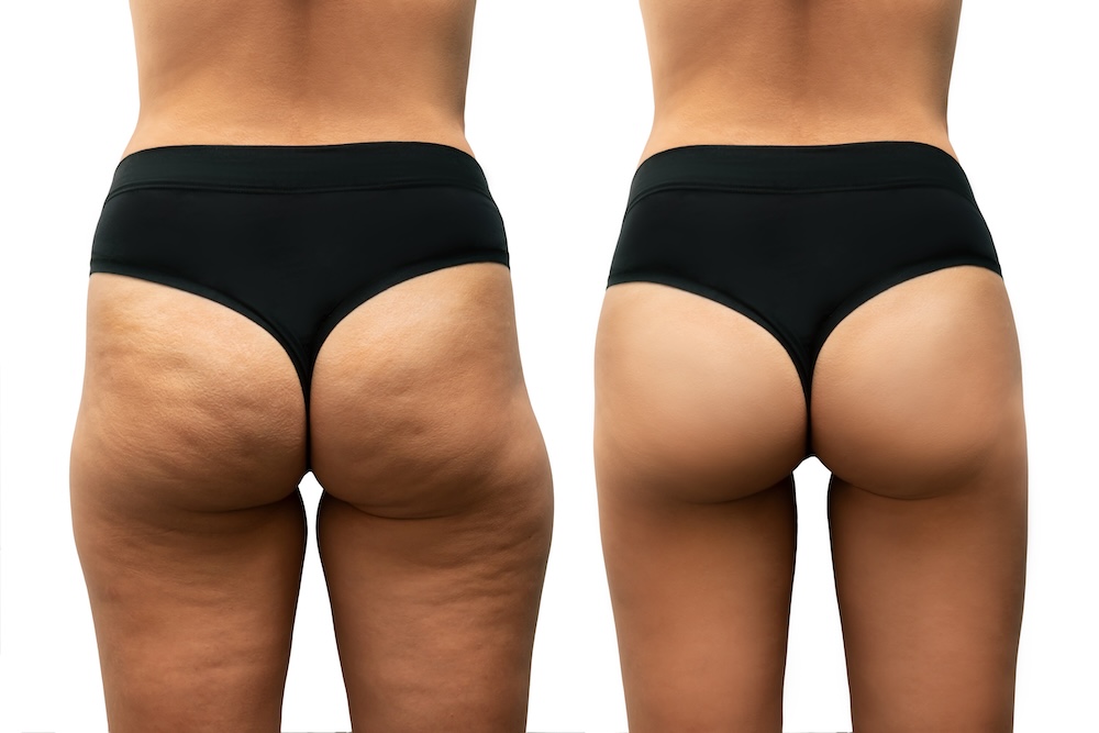 Cellulite-skin-space-massapequa-before-and-after