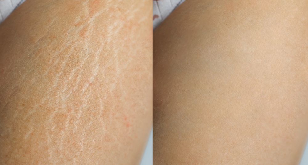 Stretch-Mark-Removal-at-skin-space-in-massapequa