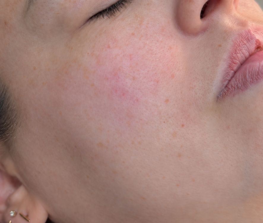 After 10 Treatments
