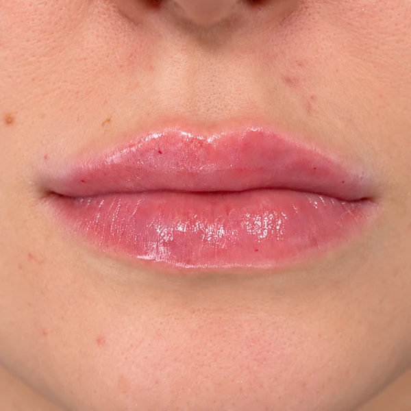 After 10 Treatments